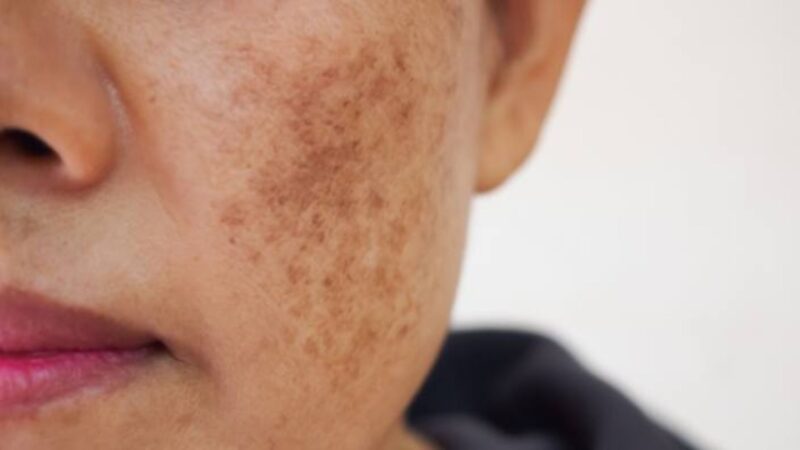 Why Does Melasma Occur During Pregnancy